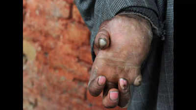 Door-to-door screening to track leprosy cases kicked off in Gurugram