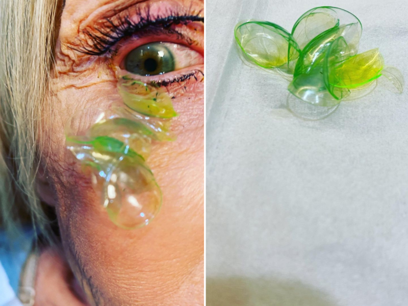 Shocking! 23 contact lenses removed from woman's eye