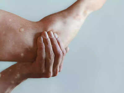 Monkeypox retreating but threat remains, experts warn