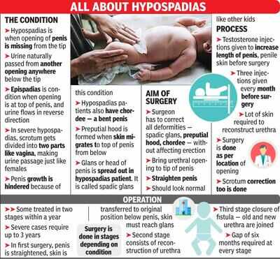 Nagpur doctor completes 4 decades of fixing congenital penile defect in newborns