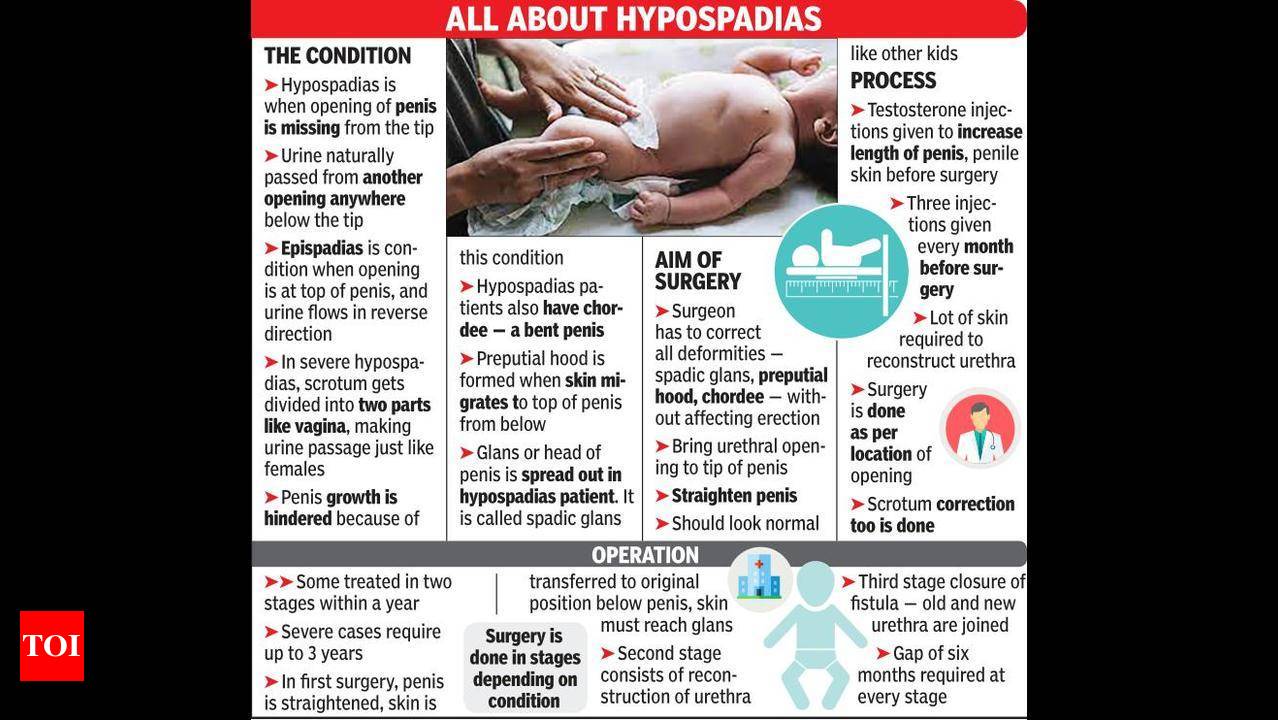 Nagpur doctor completes 4 decades of fixing congenital penile defect in  newborns | Nagpur News - Times of India