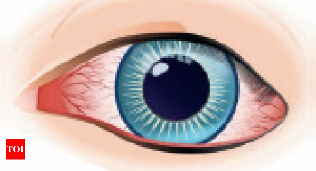 hospitals-seeing-steady-spike-in-madras-eye-cases-chennai-news