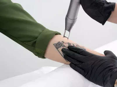 Things to consider while tattoo removal