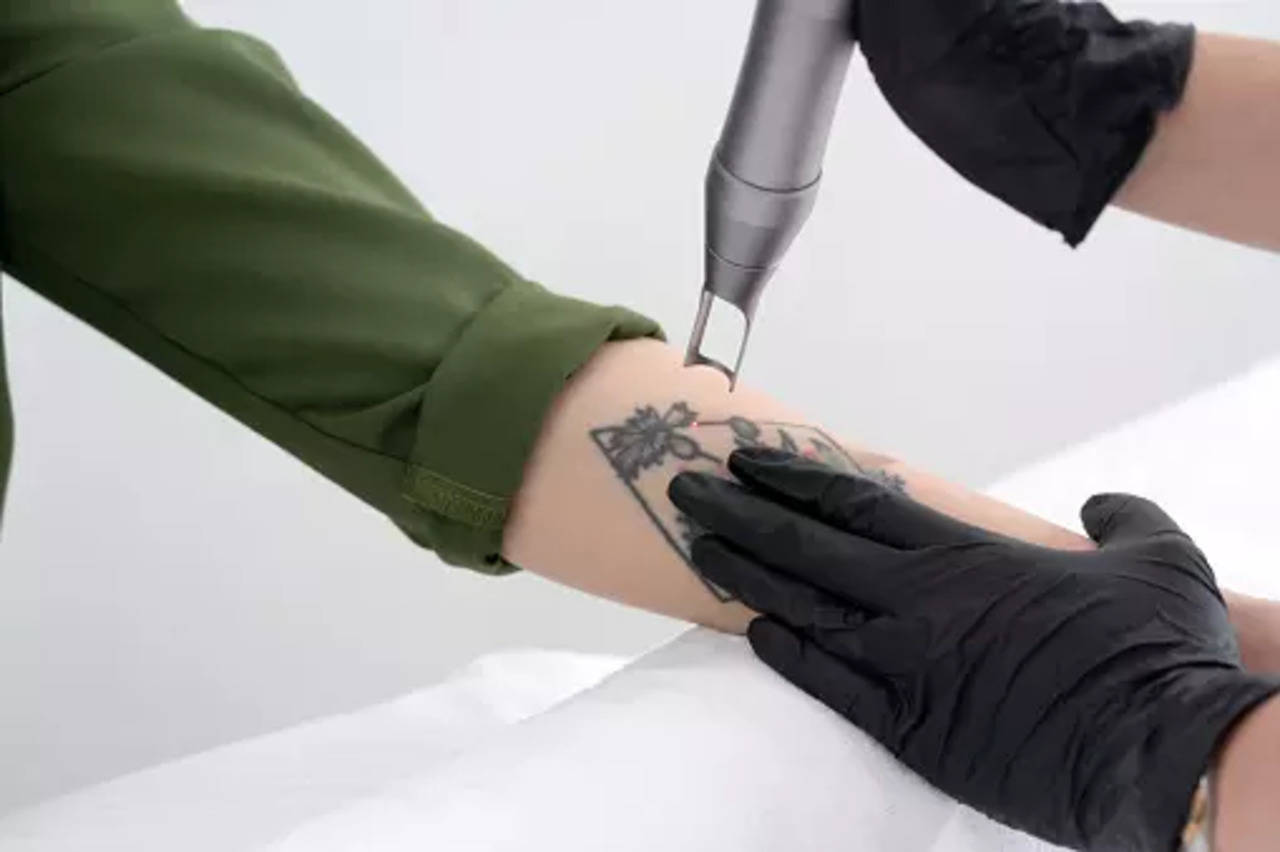 Tattoo Removal 5 Myths  5 Truths  1192 Laser  Beauty Clinic