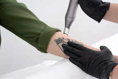 Laser Tattoo Removal FAQ Top Questions  Pinnacle Dermatology