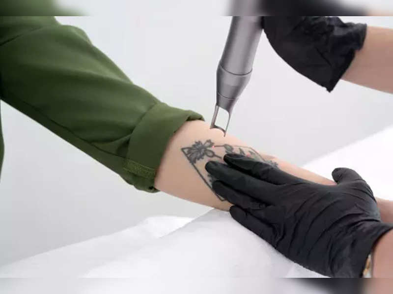Things to consider while tattoo removal - Times of India