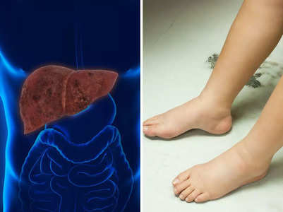 2 fatty liver disease signs in the leg & abdomen