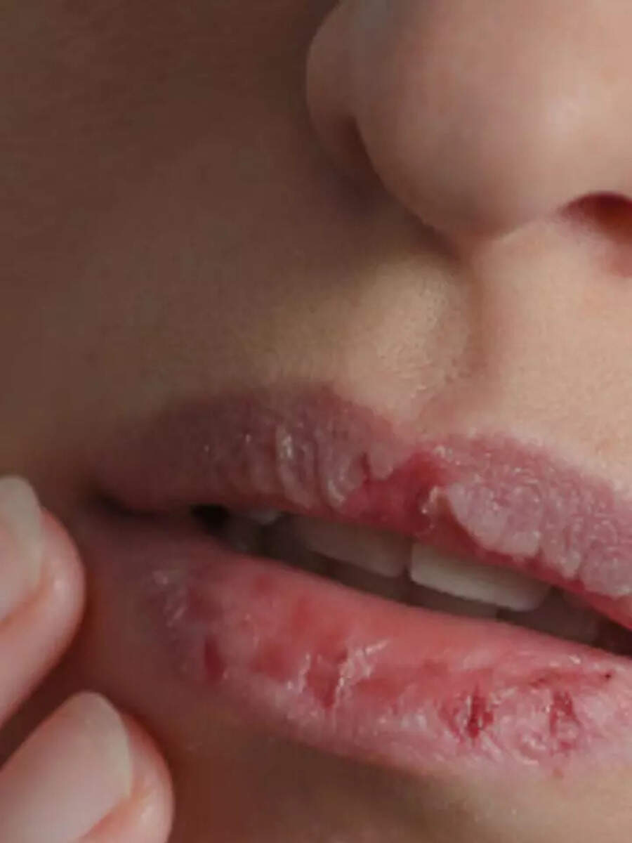 Dry lips remedy Try these 5 natural remedies for chapped lips Times Now