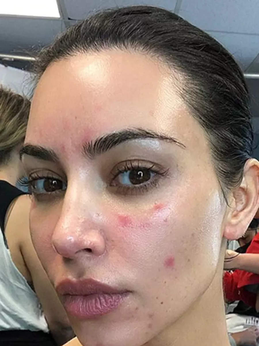 Bollywood celebs with acne scars