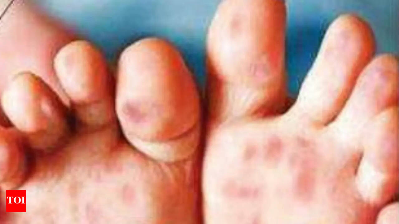 Virus Behind Hfmd Outbreak In Us Causing Illness In City Kids: Scientists | Pune  News - Times of India