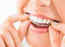 The dental health benefits of clear aligners