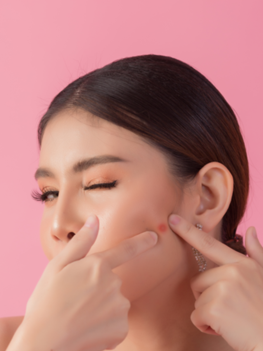 Acne Face Simple Homemade Face Wash To Treat Acne Times Now