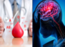 Blood type may predict risk of having stroke