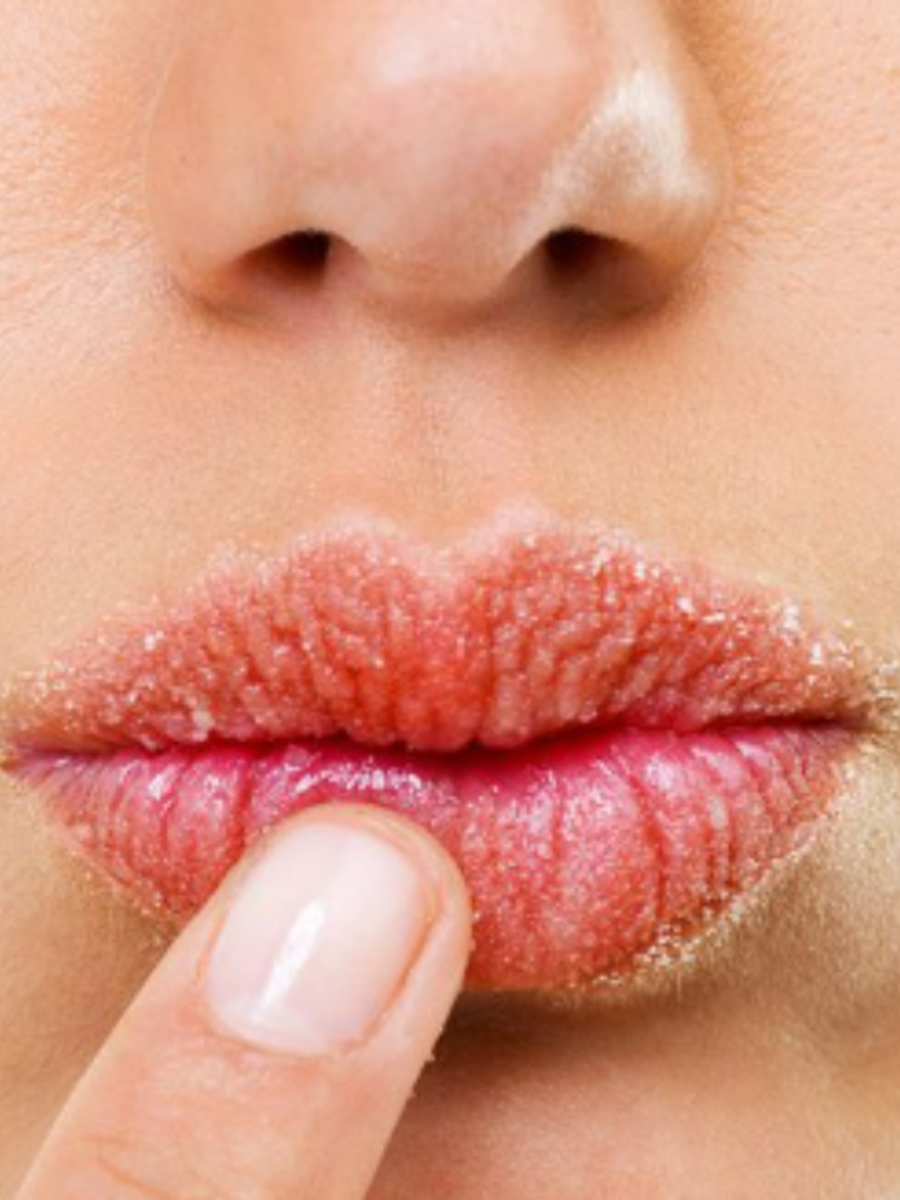 Dry lips home remedy Try these simple ingredients to treat dry lips at