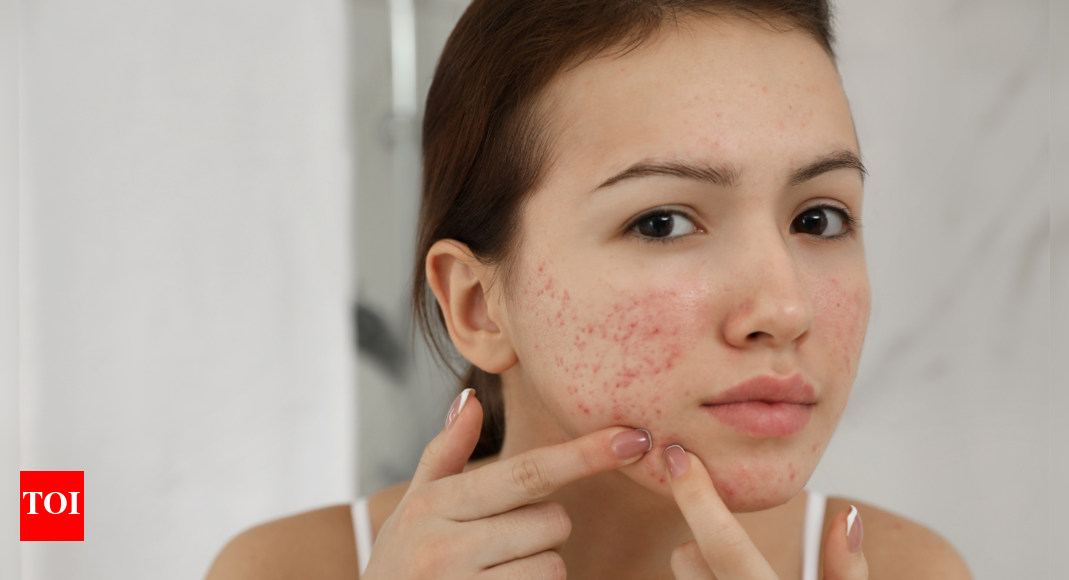 Face Serums for Acne Prone Skin Under 1000 Times of India