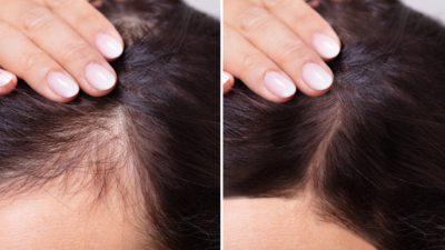Dr. Mukesh Batra Dermatologist Hair Transplant - Hair Transplantation LASER  HAIR REMOVAL DERMATOLOGIST Clinic Bahrain