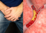 Erectile dysfunction sign of high cholesterol