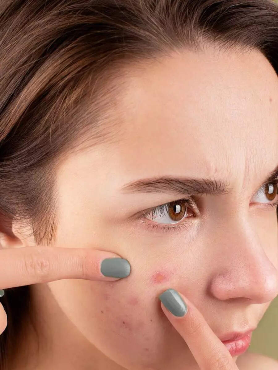 Acne skin Ayurvedic remedy to treat cystic acne Zoom TV