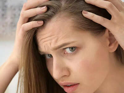 Women too suffer from receding hairline