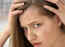Women too suffer from receding hairline