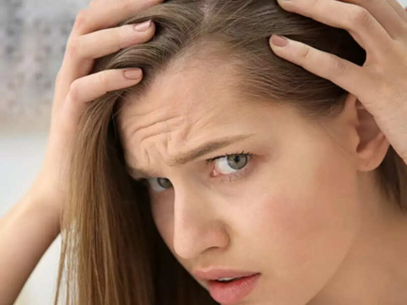 Women too suffer from receding hairline