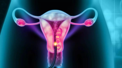 Delayed detection main cause of death in cervical cancer, say experts