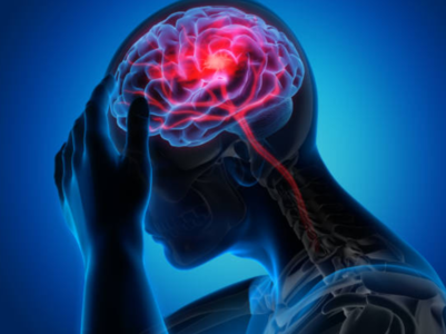Stroke: Severe headache can be a sign
