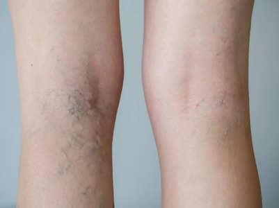 Varicose veins: THIS habit can increase risk