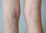 Varicose veins: THIS habit can increase risk