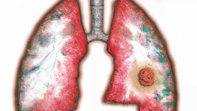 Researchers find why immunotherapy doesn't work well for lung cancer treatment