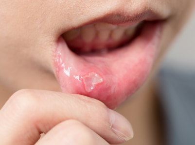 Never ignore these symptoms of oral cancer