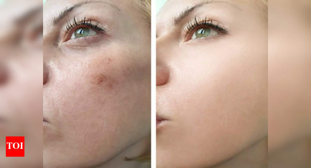 Skin Pigmentation Tips to fade the spots away Times of India