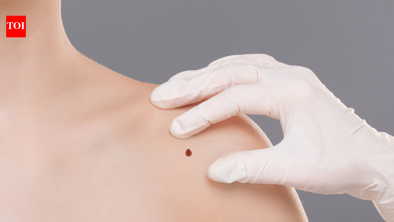 Skin Cancer Symptoms: 21 year old's growing mole on collarbone turned ...