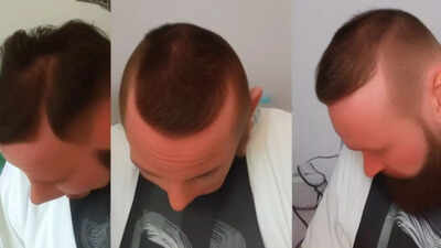 Soon, hair transplants at dental clinics in Maharashtra