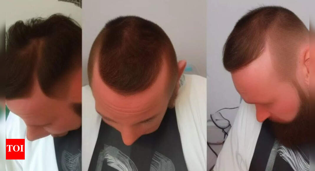 Soon, hair transplants at dental clinics in Maharashtra | Nagpur News - Times of India Soon, hair transplants at dental clinics in Maharashtra | Nagpur News - Times of India