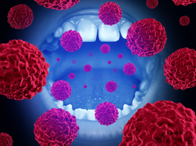 Oral cancer symptoms you should not ignore