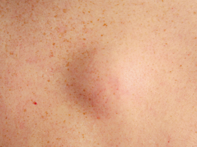 32-year-old's pain was from a rare tumor