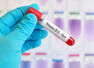 How B12 deficiency can affect the body