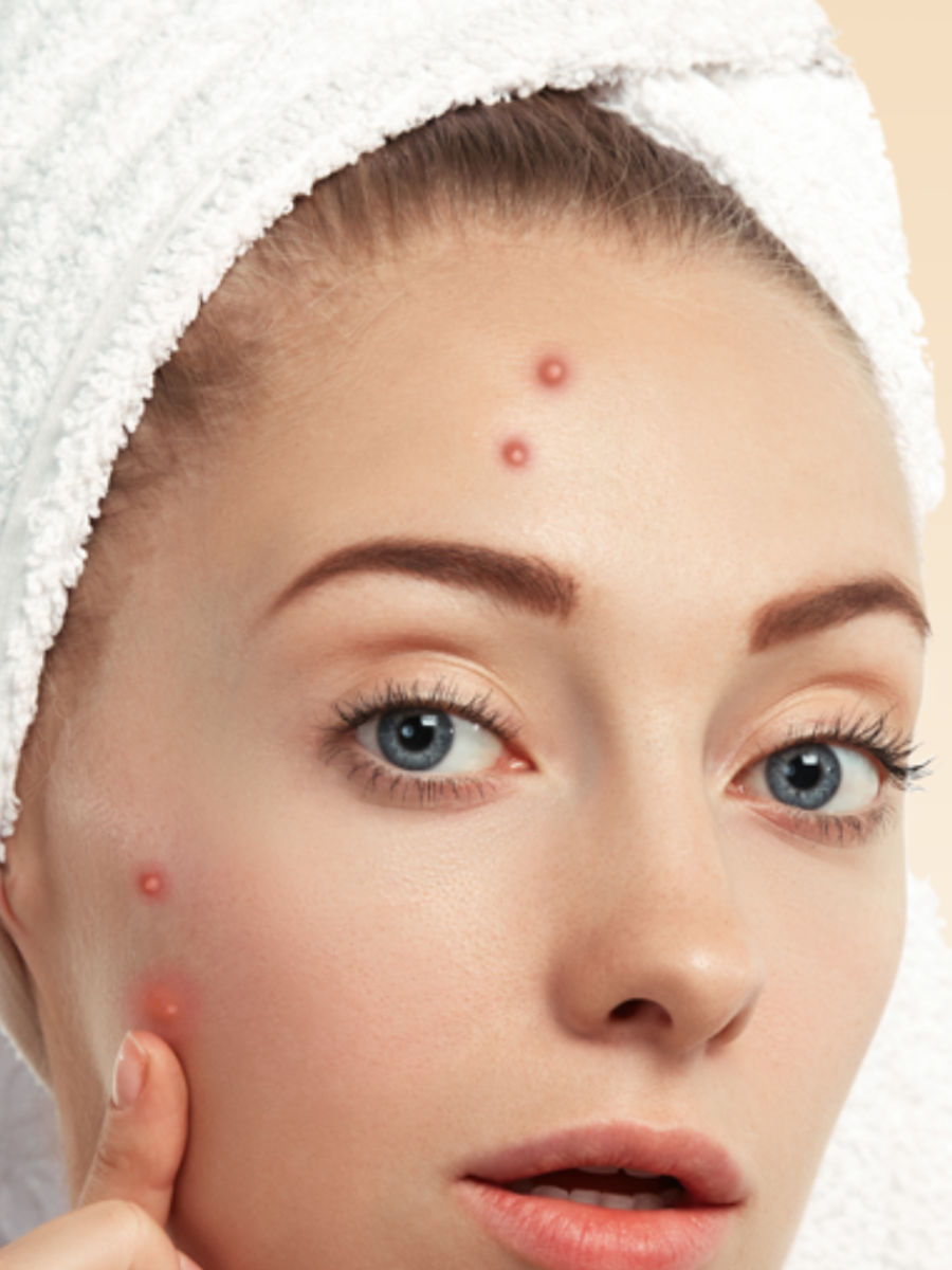 How to remove pimples on face 9 tips for clear skin Zoom TV