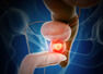 When to get screened for prostate cancer?