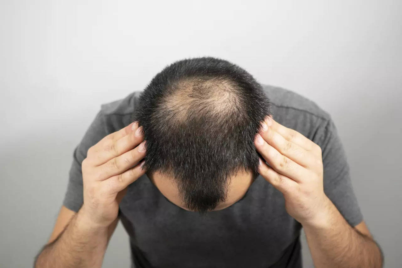 Best Hair Fall Treatment for Men and where to find it - AHS India