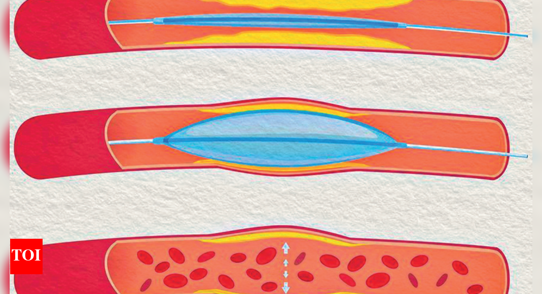 Drug-coated Balloons Better Than Stents: Docs | Chennai News - The ...