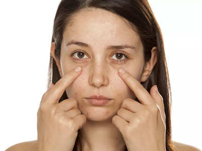 How to get rid of dark circles permanently