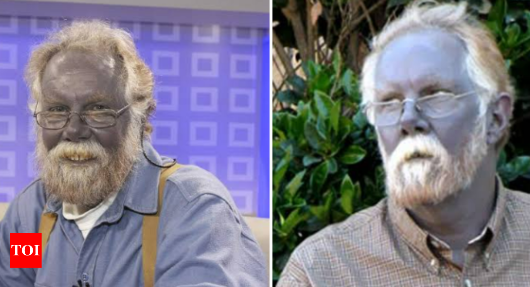 Meet the real-life ‘smurf’: Man turns blue after consuming dietary ...