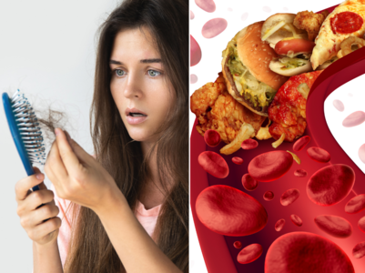 Hair loss and whitening from high cholesterol