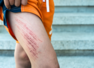 5 ways to prevent and heal from gym injuries