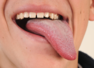 Vitamin D deficiency signs on your tongue