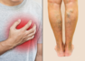 Swelling in legs may be sign of heart failure