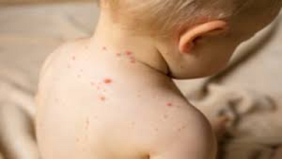 Chicken pox, measles cases on rise, vaccinated adults infected in Hyderabad
