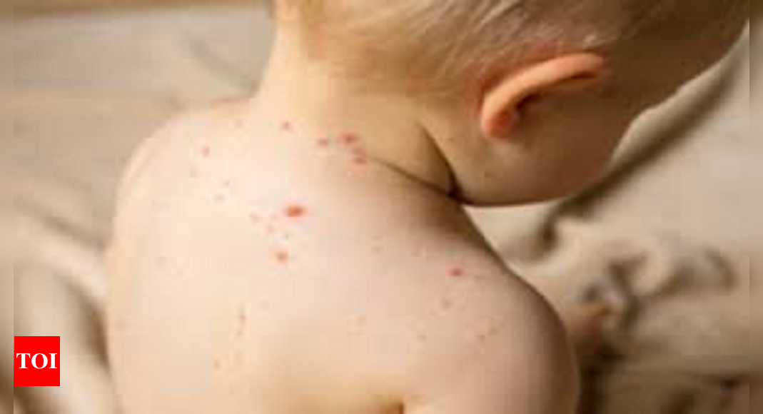 chicken-pox-measles-cases-on-rise-vaccinated-adults-infected